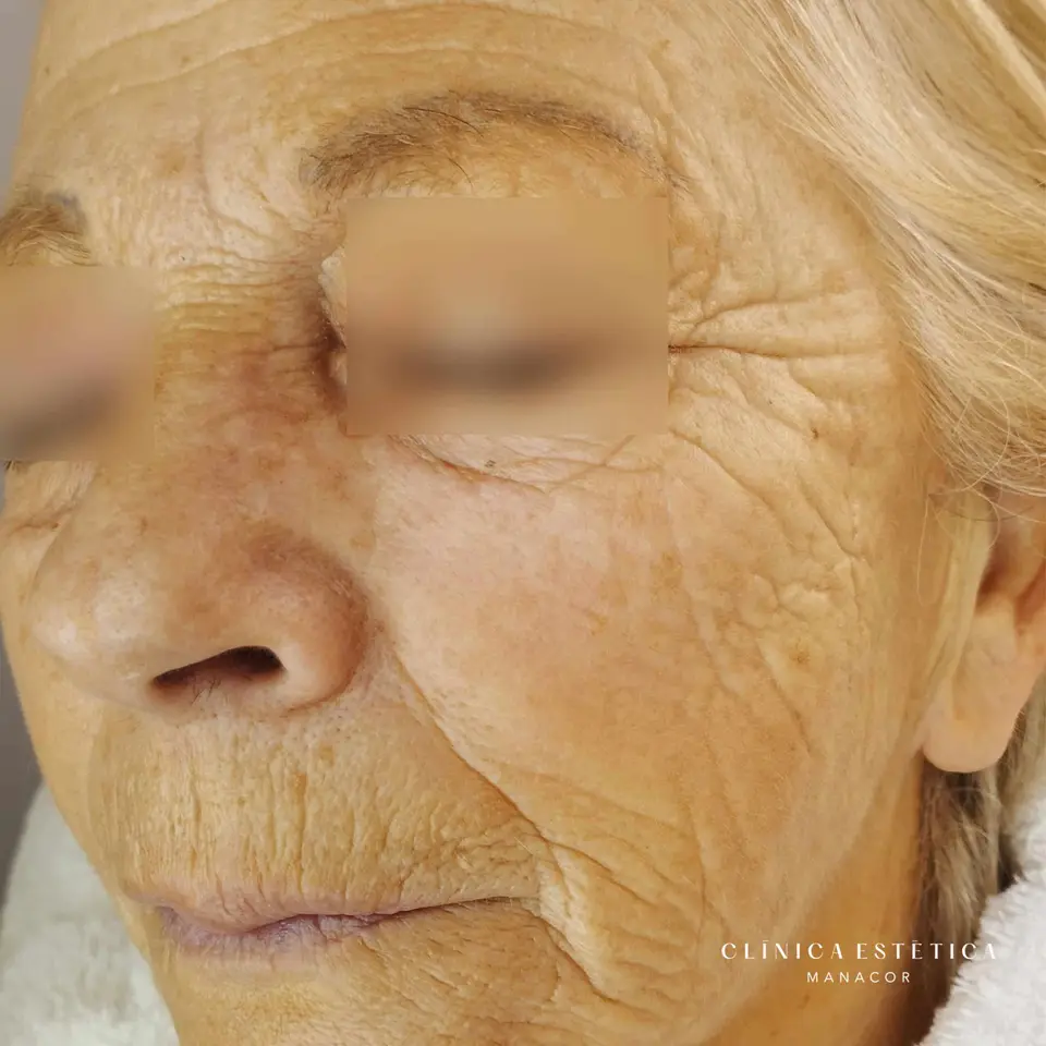 Antes: Rejuvenecimiento facial con ácido hialurónico e hilos tensores