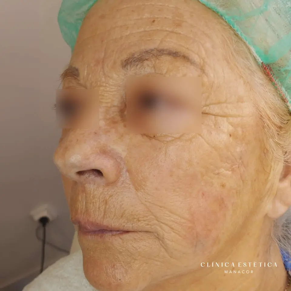 Después: Rejuvenecimiento facial con ácido hialurónico e hilos tensores