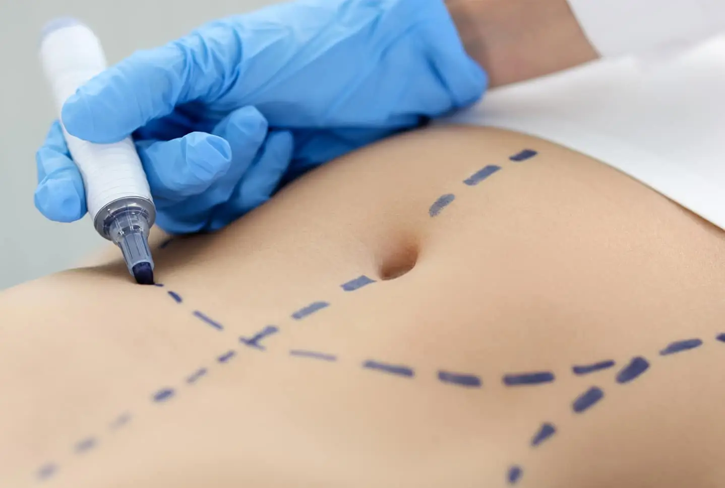 Abdomen con marcas de planificación quirúrgica