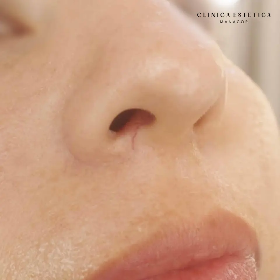 Before: Spider vein removal with Nd:YAG laser
