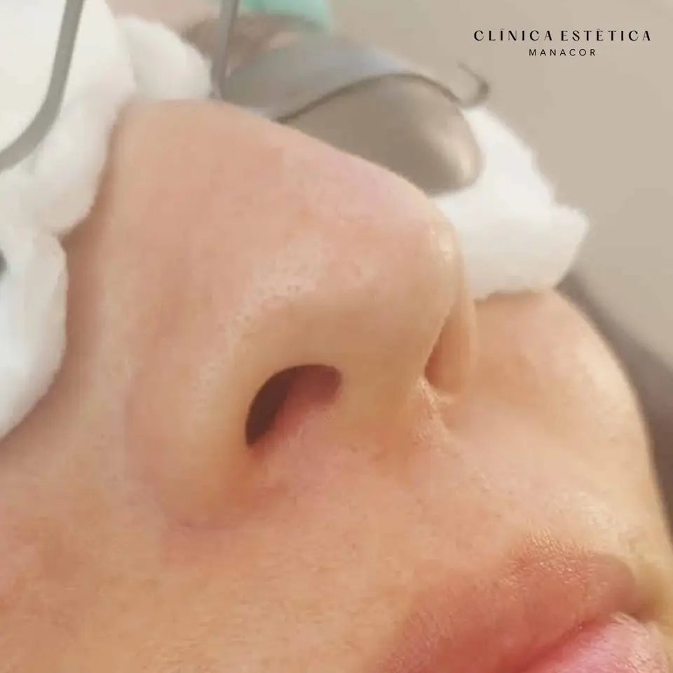After: Spider vein removal with Nd:YAG laser