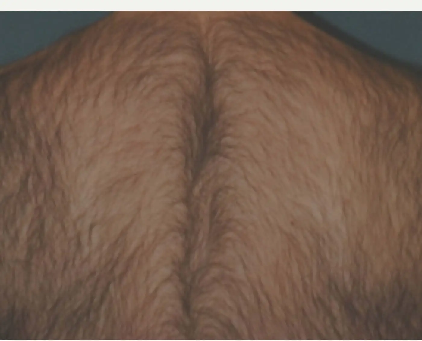 Antes: espalda