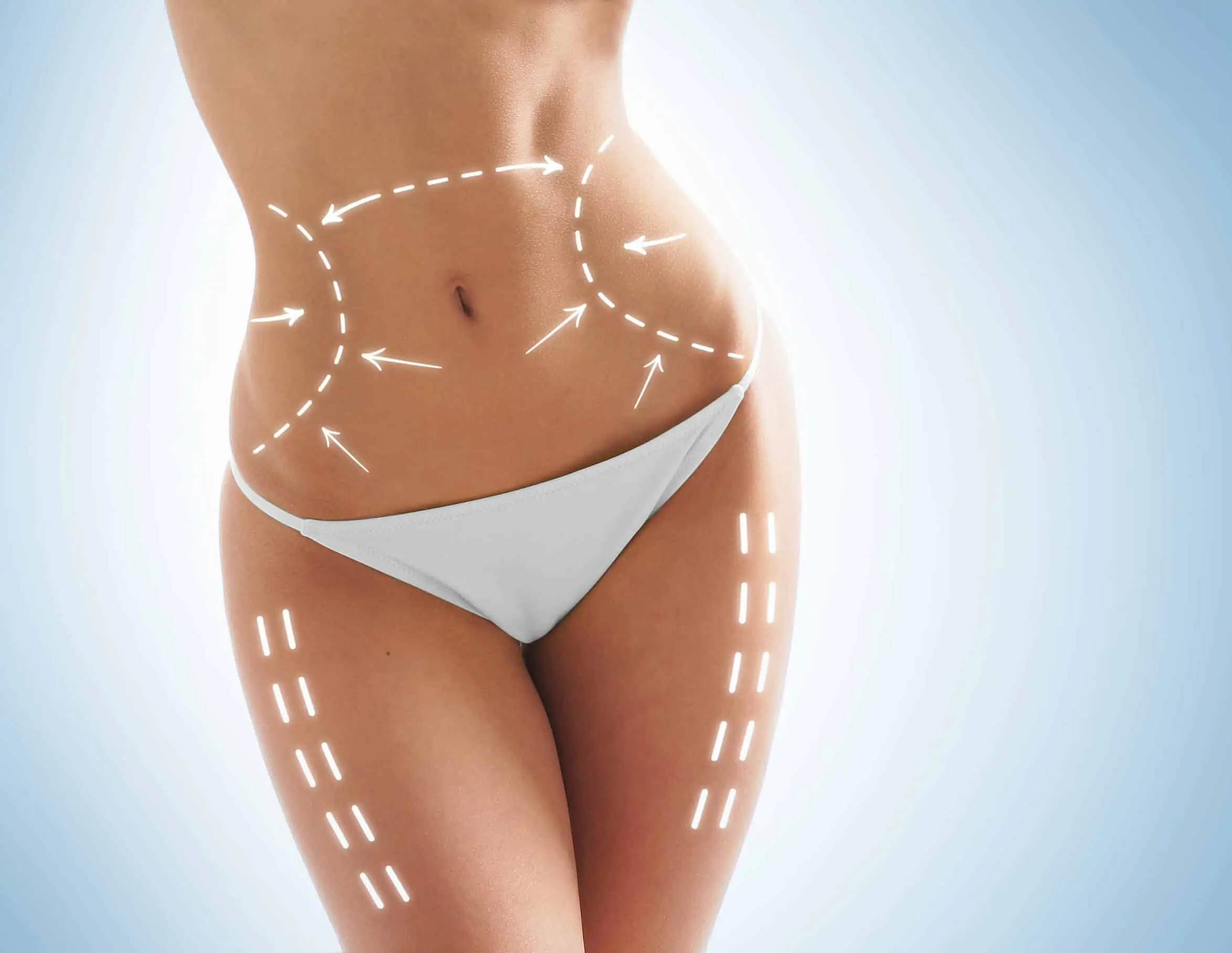 Ilustración de zonas de tratamiento de grasa localizada en abdomen y muslos
