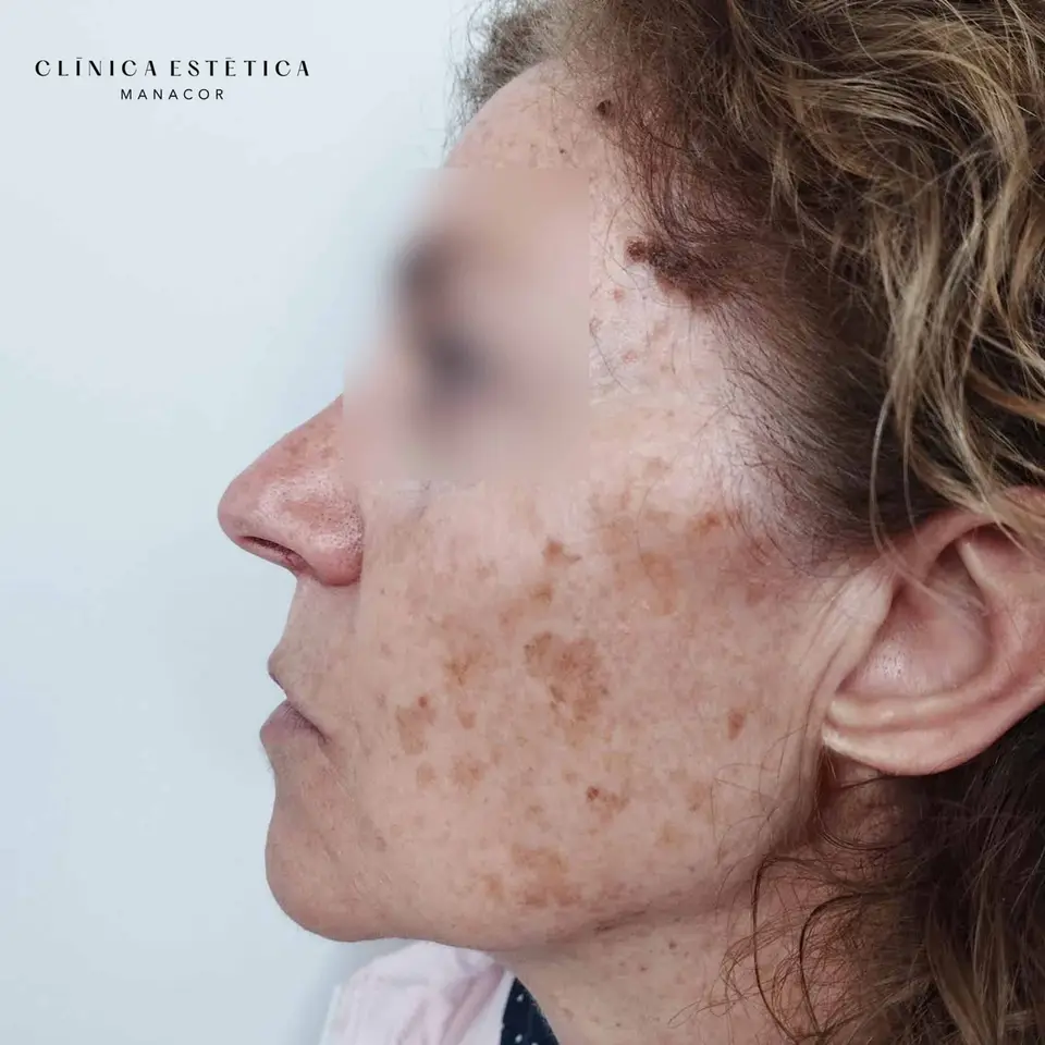 Antes: Eliminación de manchas solares con luz pulsada intensa (IPL)