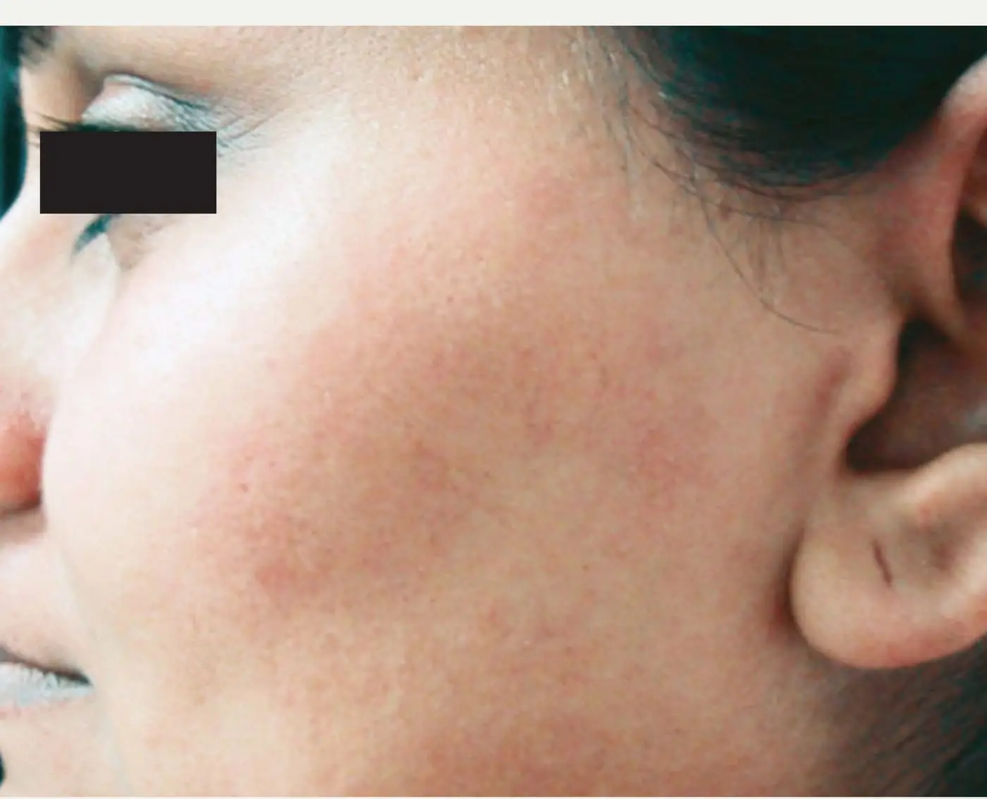 Después: depilación de rostro con GentleMax Pro (imagen del fabricante)