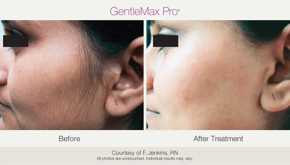 Antes y después: Depilación facial (imagen del fabricante Candela)