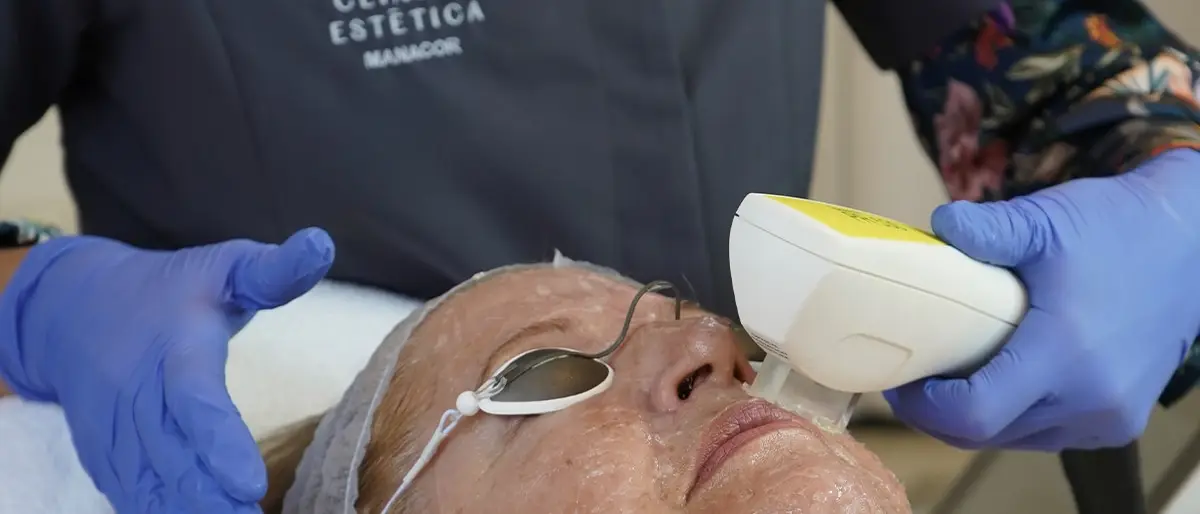 Tratamiento con luz pulsada intensa en Clínica Estética Manacor
