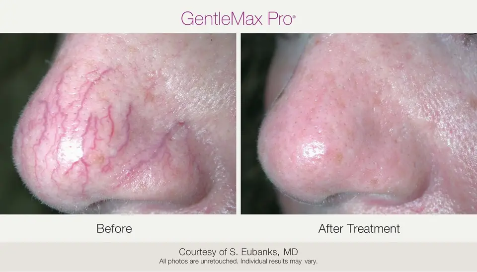 Antes y después: Lesiones vasculares (Nd:YAG 1064 nm) (imagen del fabricante Candela)