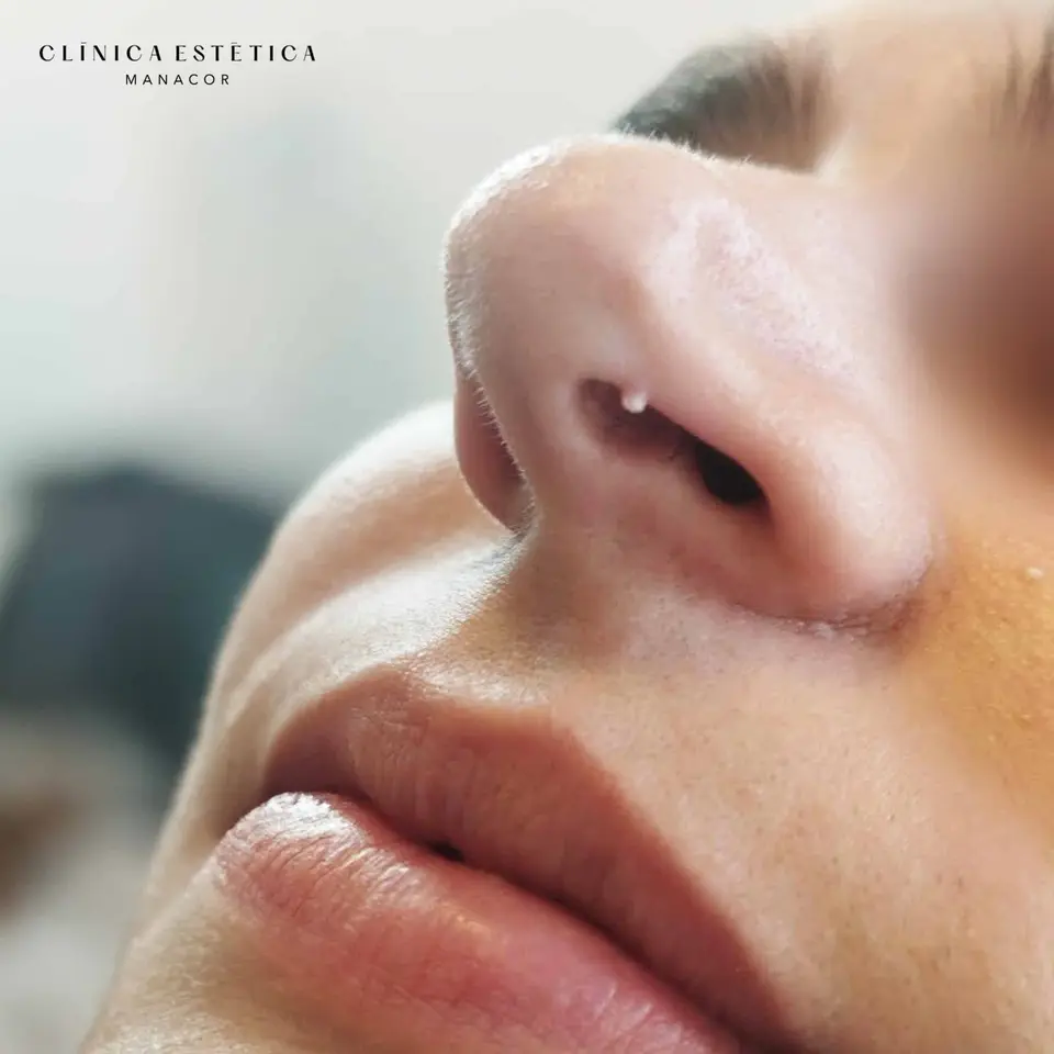 Before: Wart removal