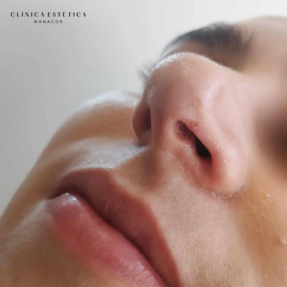 After: Wart removal