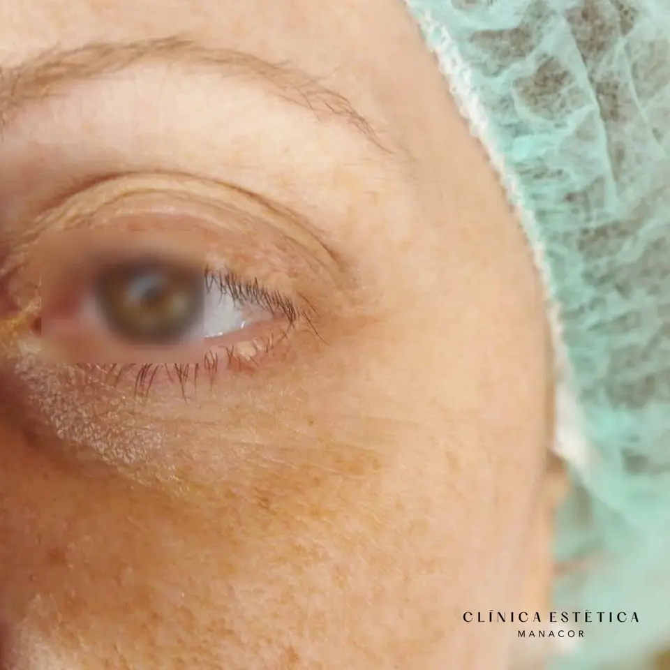 Before: Removal of a skin wart on the eyelid