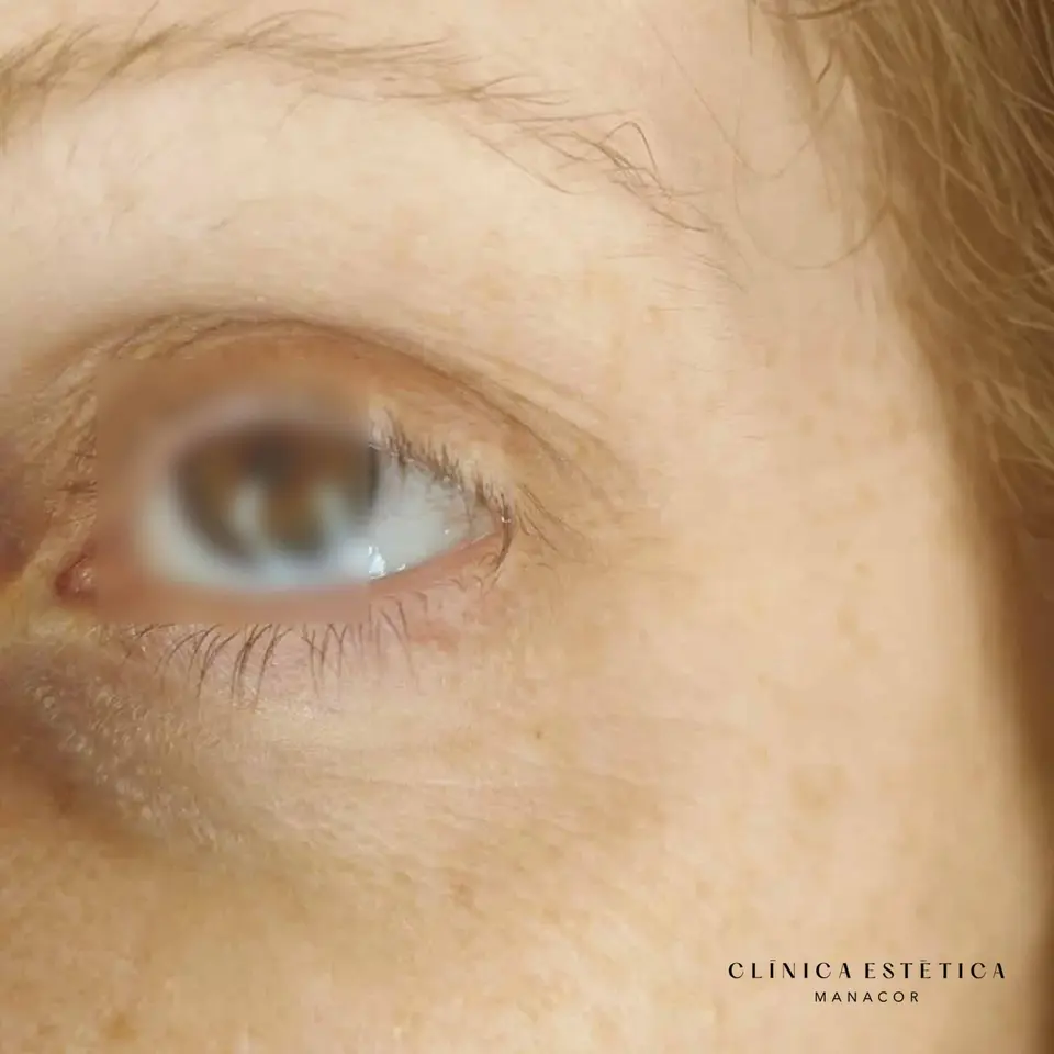 After: Removal of a skin wart on the eyelid